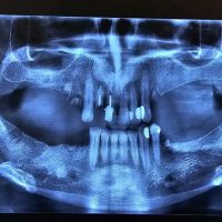 قبل از ایمپلنت مورد 4-1