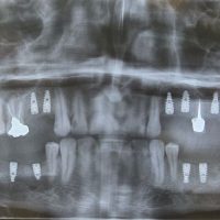 بعد از ایمپلنت مورد 3-2