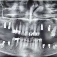 بعد از ایمپلنت مورد 6-2
