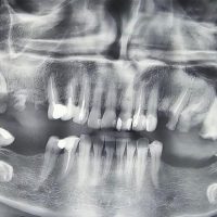 قبل از ایمپلنت مورد 6-1