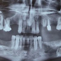 قبل از ایمپلنت مورد 3-1