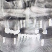 ایمپلنت دندان1-2