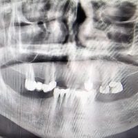 ایمپلنت دندان1-1