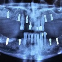 بعد از ایمپلنت مورد 4-2