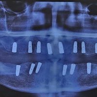 بعد از ایمپلنت مورد 5-2