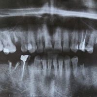 قبل از ایمپلنت2-1