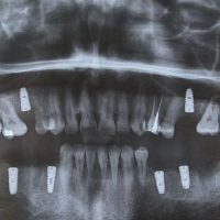 بعد از ایمپلنت2-2