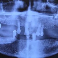 قبل از ایمپلنت مورد 5-1