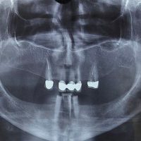 قبل از ایمپلنت مورد 7-1