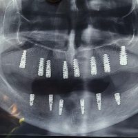 بعد از ایمپلنت مورد 7-2