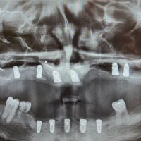 بعد از ایمپلنت مورد 8-2