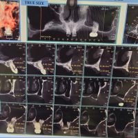 قبل از ایمپلنت مورد 8-1